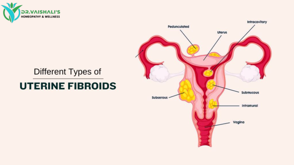 fibroids in uterus treatment