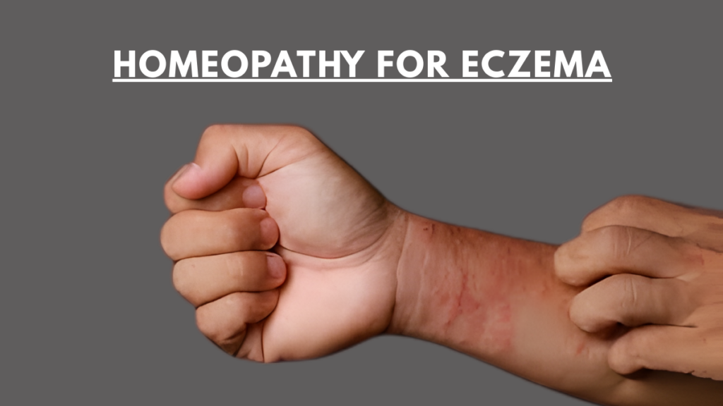homeopathy for eczema