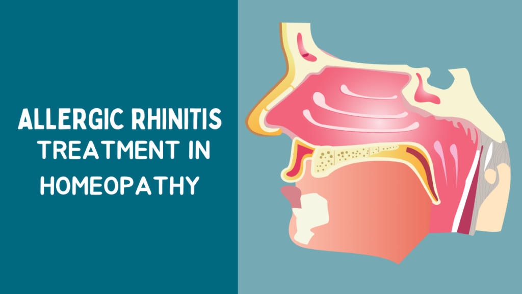 Allergic Rhinitis Treatment in Homeopathy